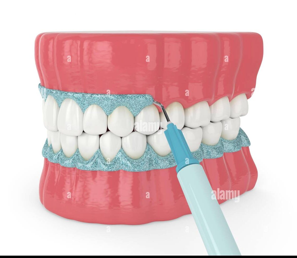 3d-render-of-jaw-with-gingival-mask-before-teeth-bleaching-protecting-the-gums-before-teeth-whitening-concept-2END8X8